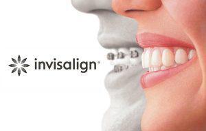 Invisalign® Orthodontist in Roseville, CA